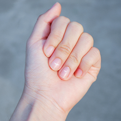 Brittle Nails