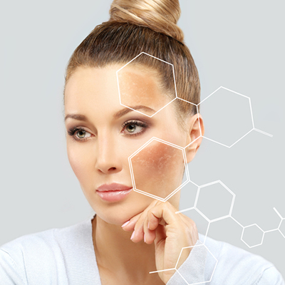 Hyper Pigmentation